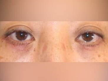 Lower Eyelid Surgery After