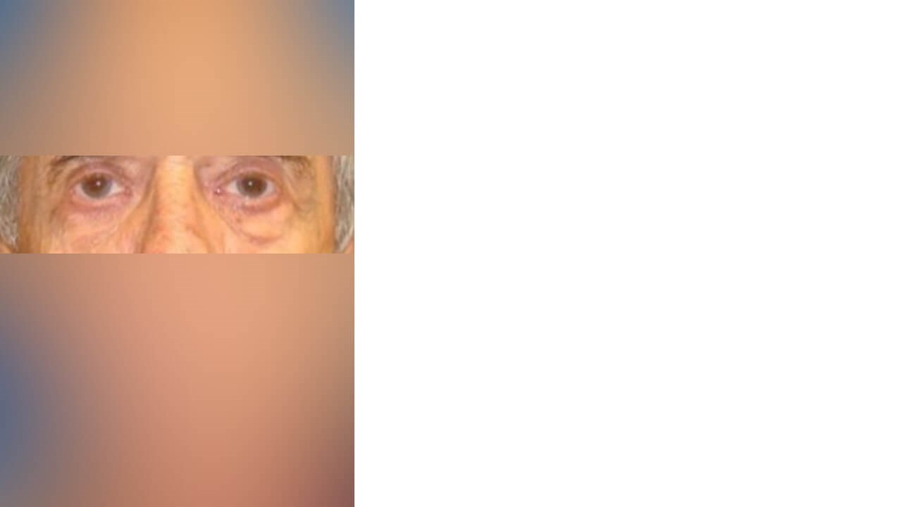 Lower Eyelid Surgery Before