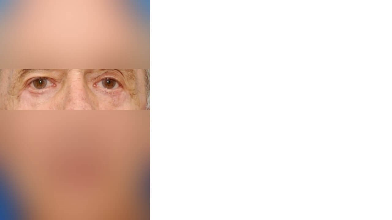 Lower Eyelid Surgery After