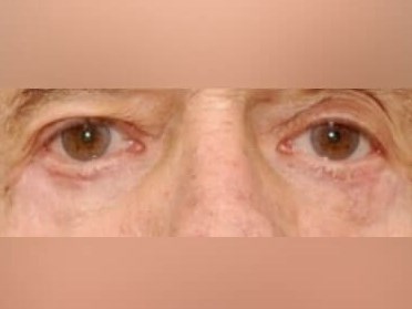 Lower Eyelid Surgery After