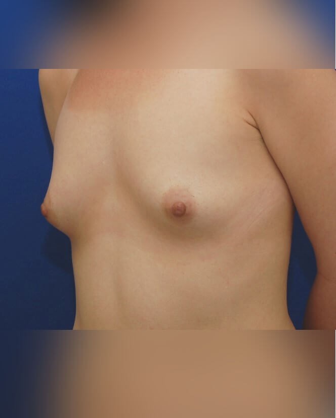 Breast Augmentation Before