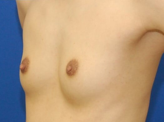 Breast Augmentation Before