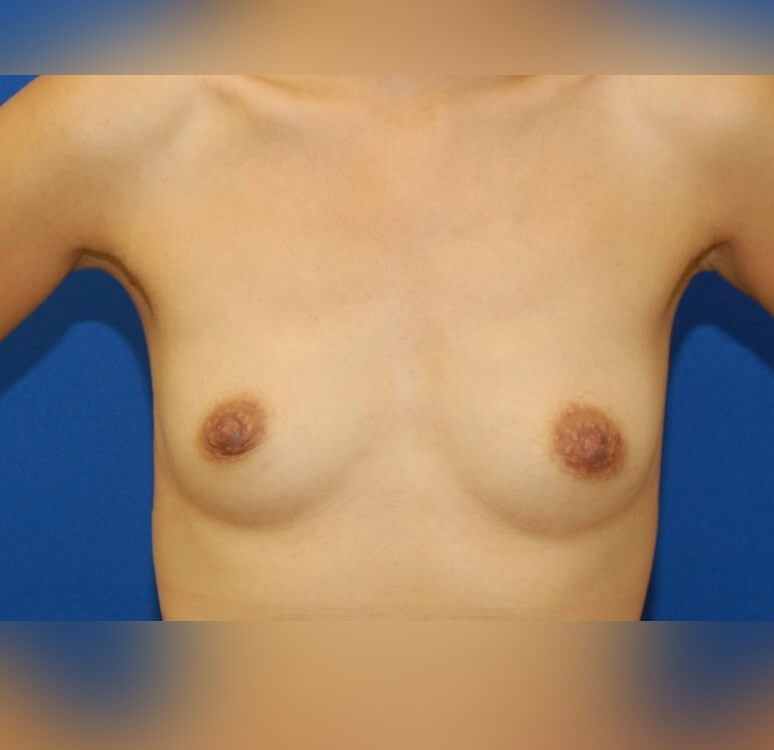 Breast Augmentation Before