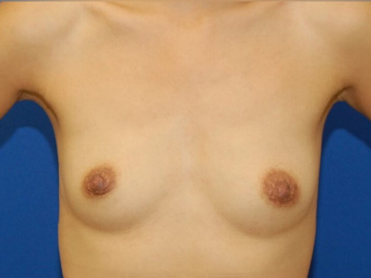 Breast Augmentation Before