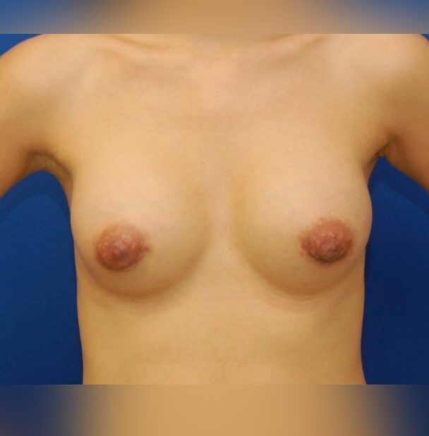 Breast Augmentation After