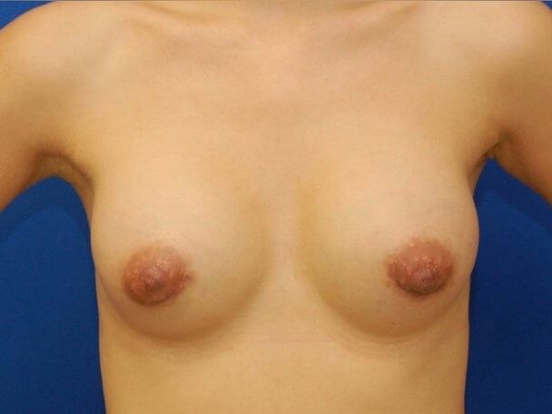 Breast Augmentation After