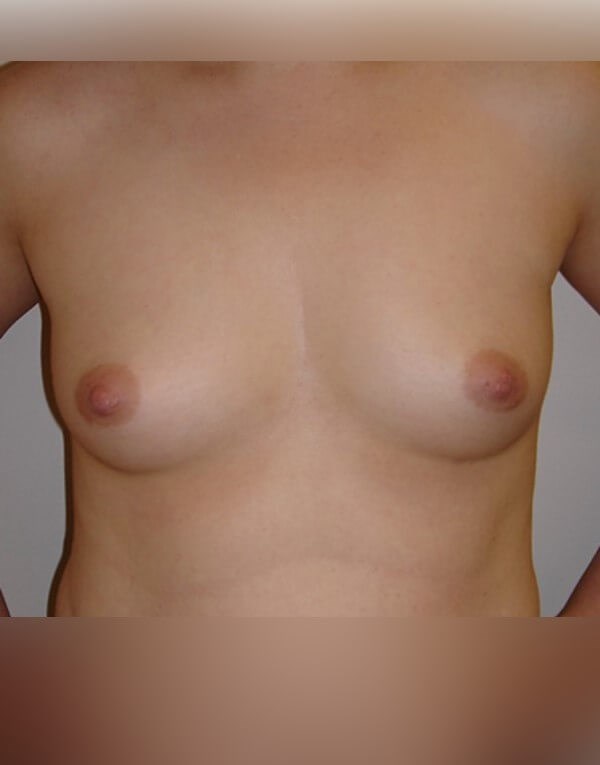 Breast Augmentation Before