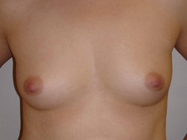 Breast Augmentation Before