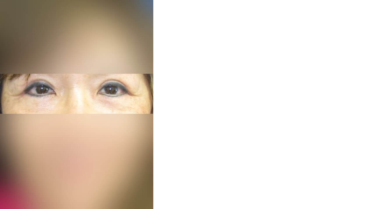 Lower Eyelid Surgery After