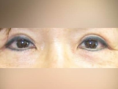 Lower Eyelid Surgery After