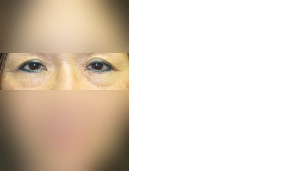 Lower Eyelid Surgery Before