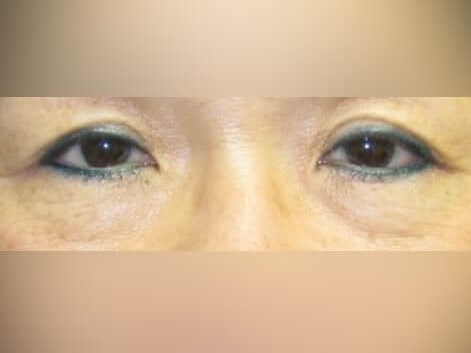 Lower Eyelid Surgery Before