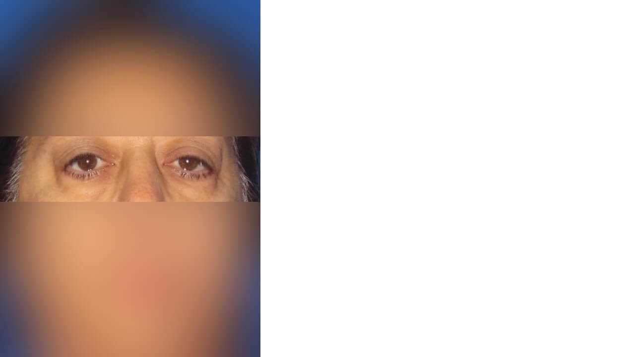 Lower Eyelid Surgery Before