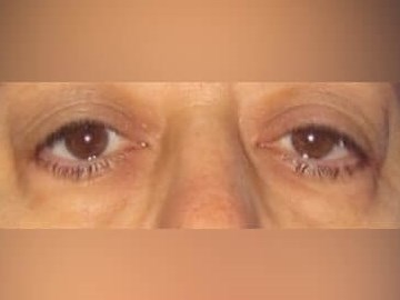 Lower Eyelid Surgery Before