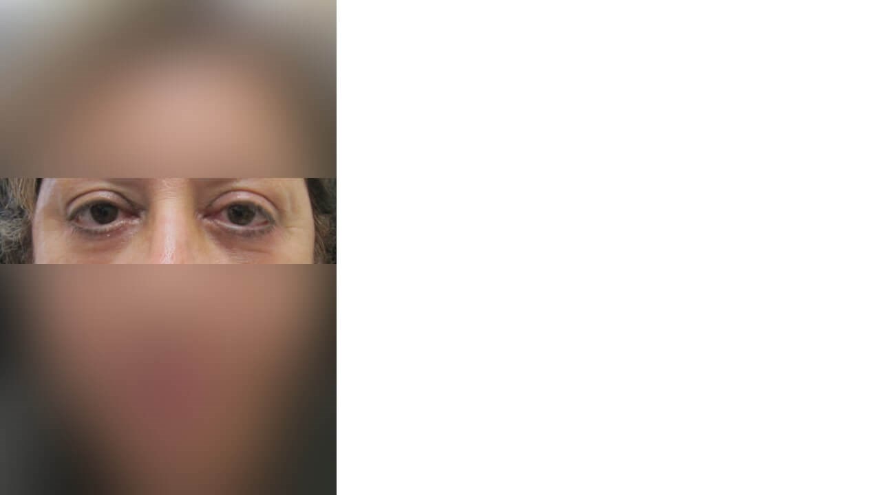 Lower Eyelid Surgery After