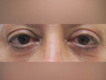 Lower Eyelid Surgery After