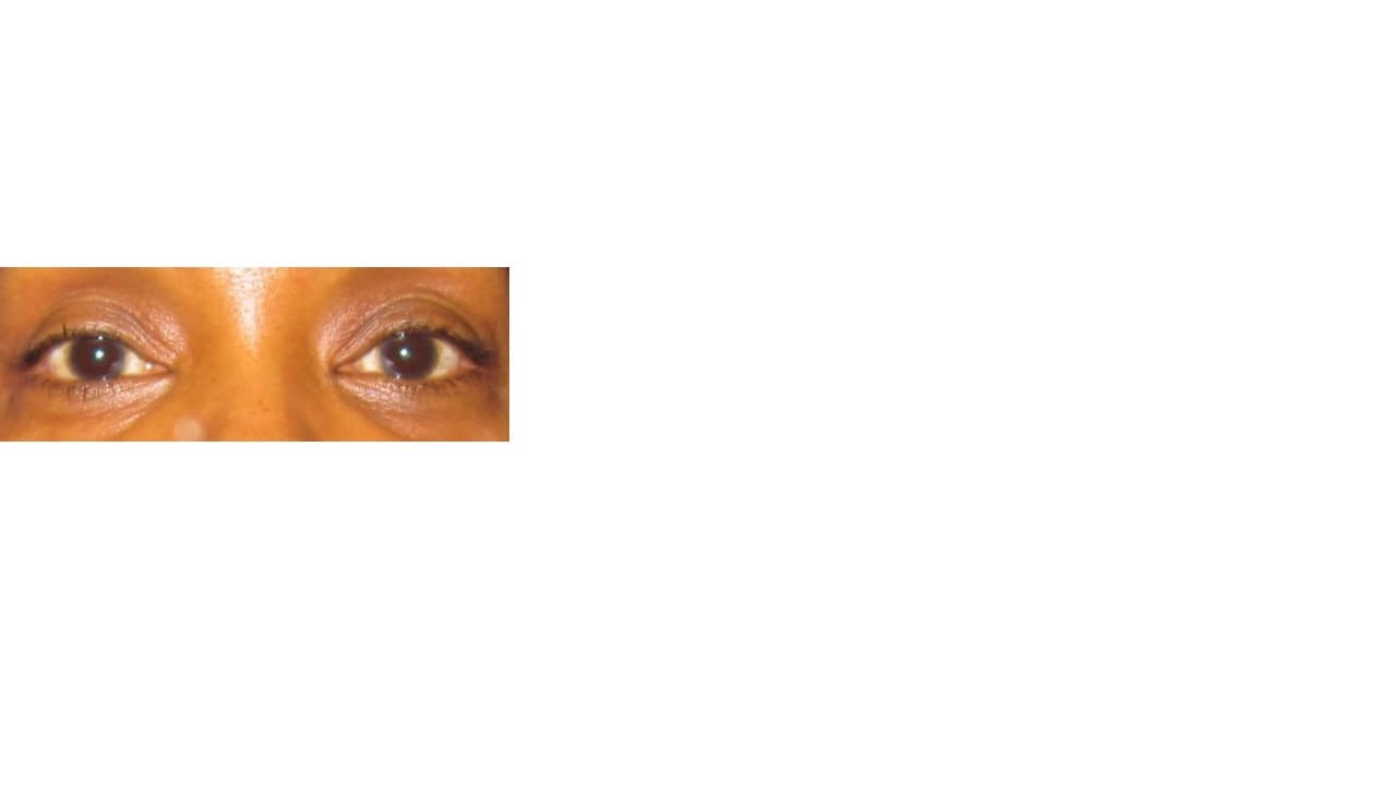 Lower Eyelid Surgery Before