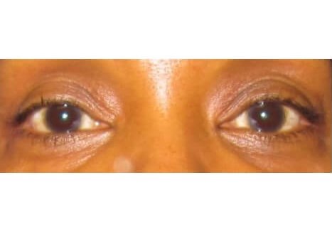 Lower Eyelid Surgery Before