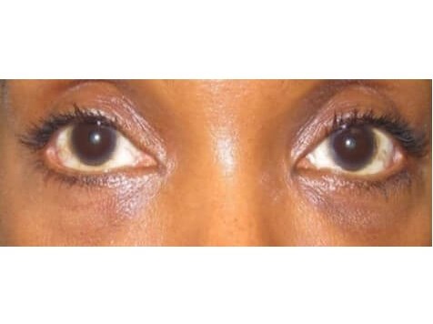 Lower Eyelid Surgery After