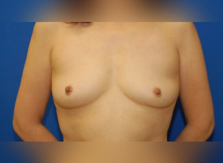 Breast Augmentation Before