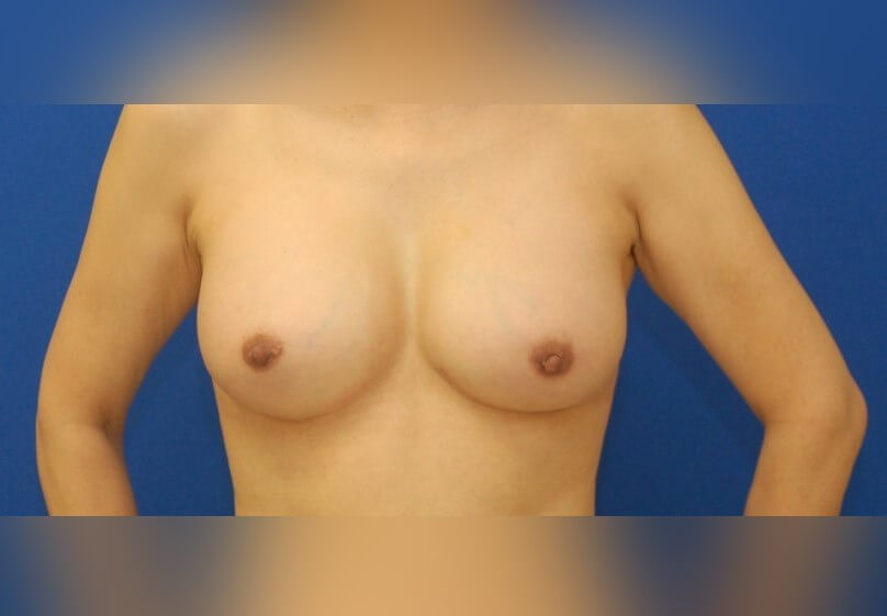 Breast Augmentation After