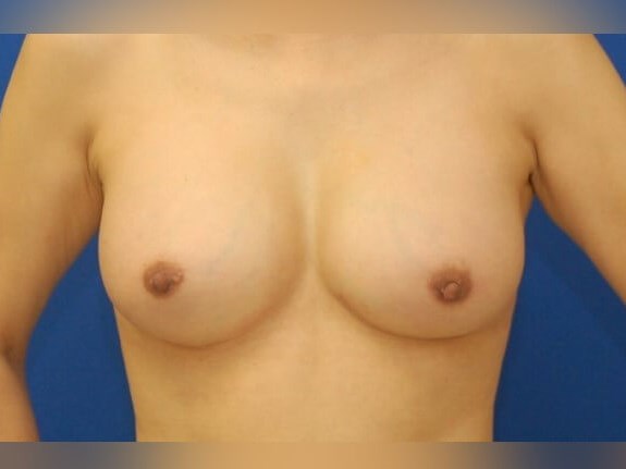 Breast Augmentation After