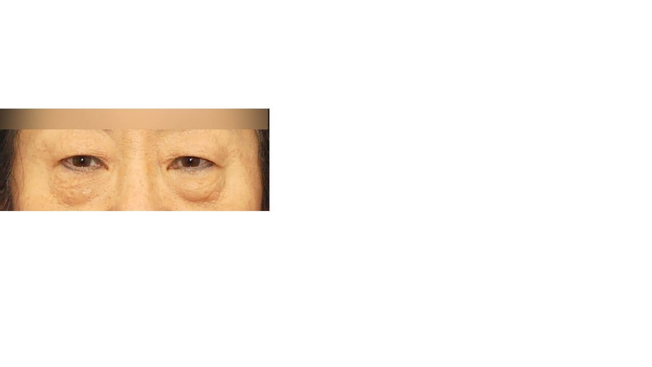 Lower Eyelid Surgery Before