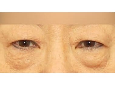 Lower Eyelid Surgery Before