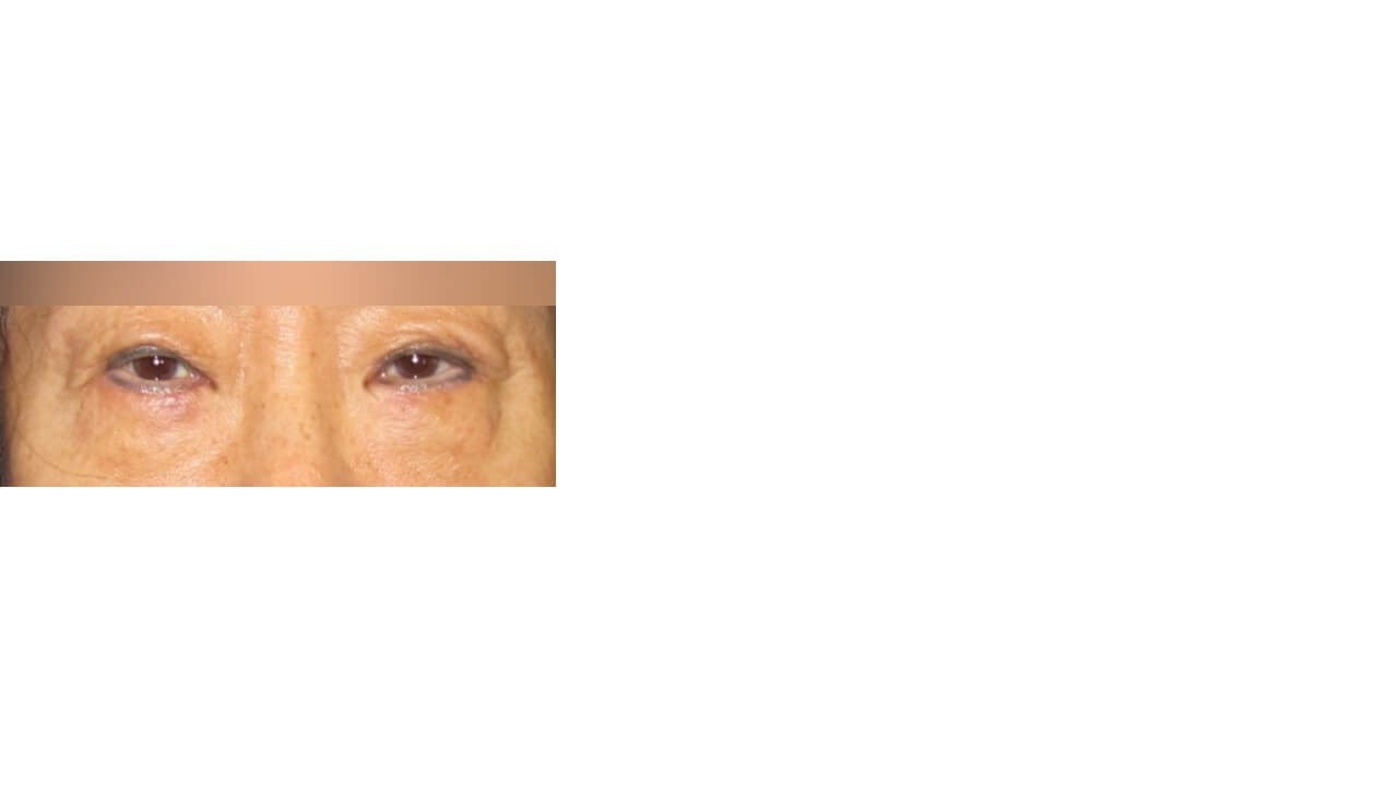Lower Eyelid Surgery After