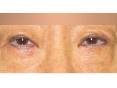 Lower Eyelid Surgery After