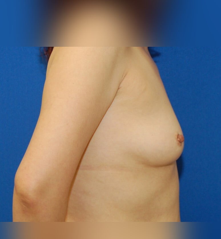 Breast Augmentation Before
