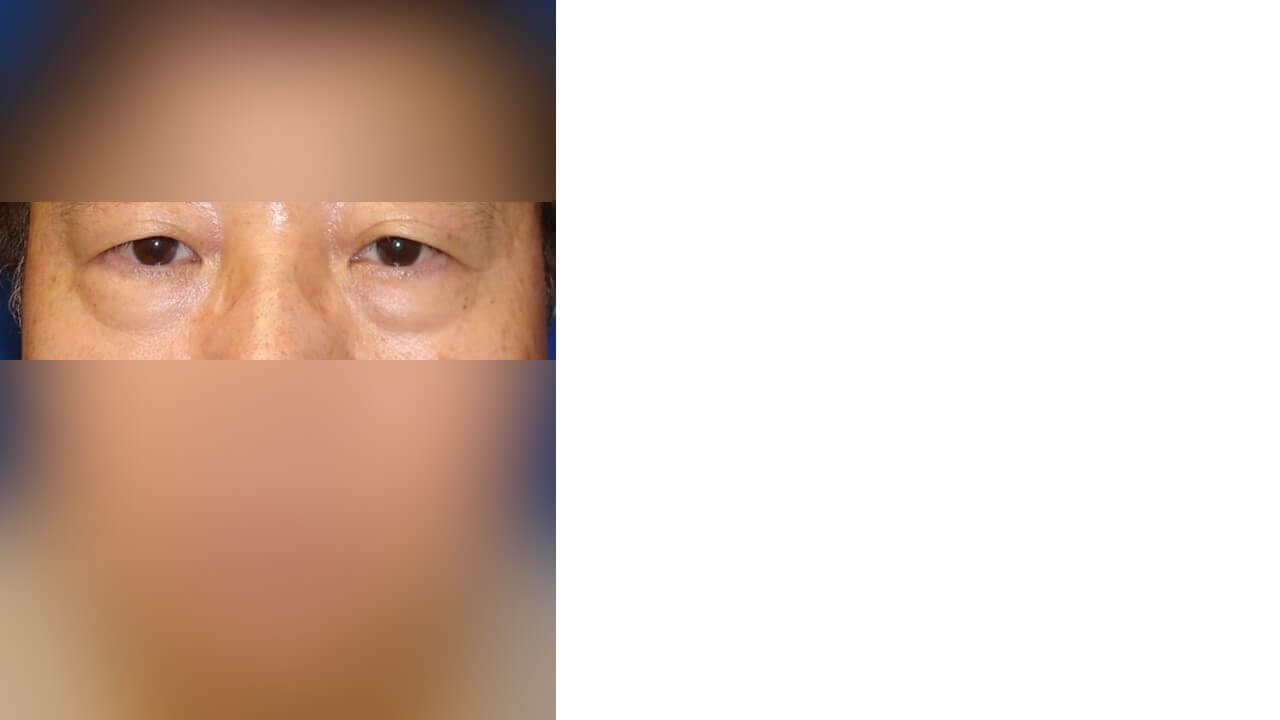 Lower Eyelid Surgery Before
