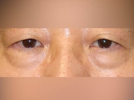 Lower Eyelid Surgery Before