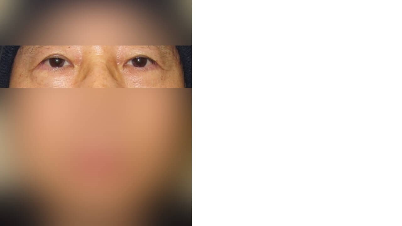 Lower Eyelid Surgery After