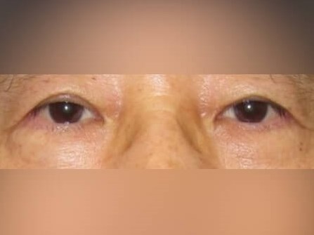 Lower Eyelid Surgery After