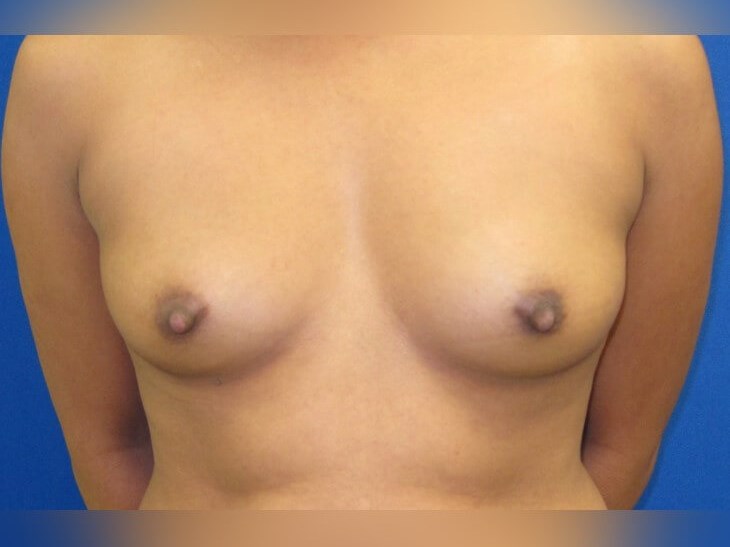 Breast Augmentation Before