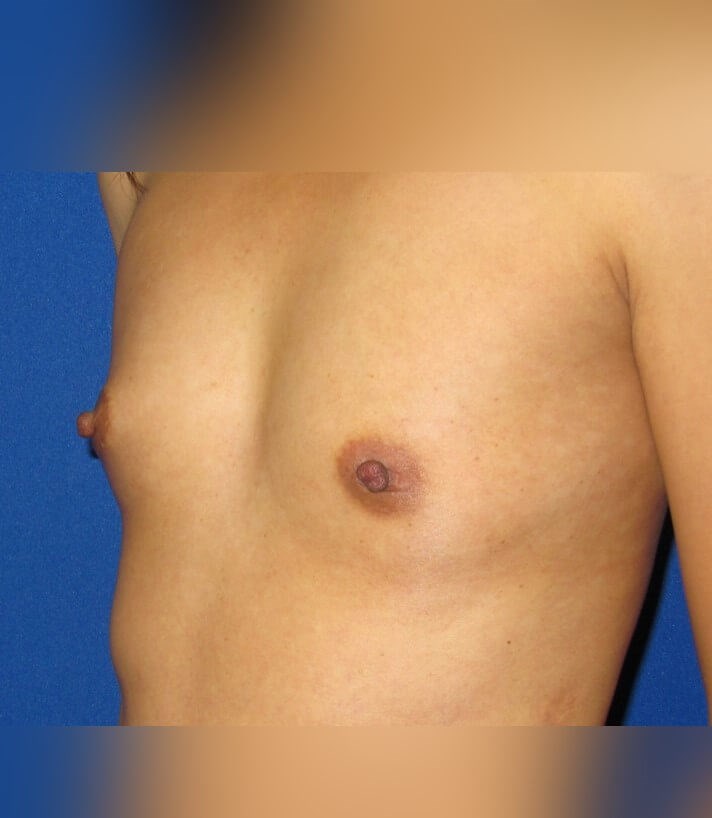 Breast Augmentation Before