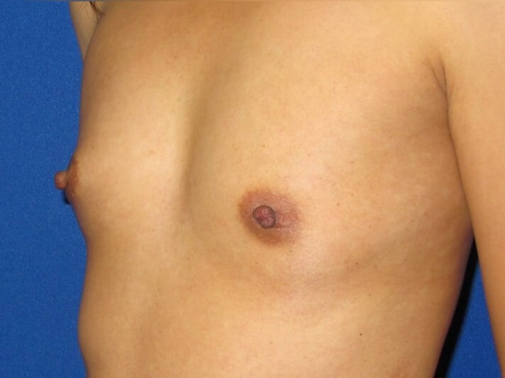 Breast Augmentation Before