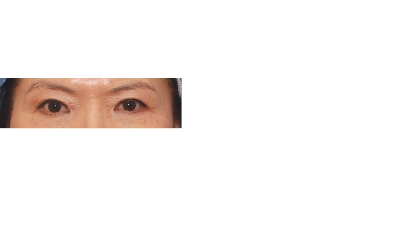 Lower Eyelid Surgery Before