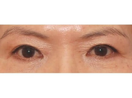 Lower Eyelid Surgery Before