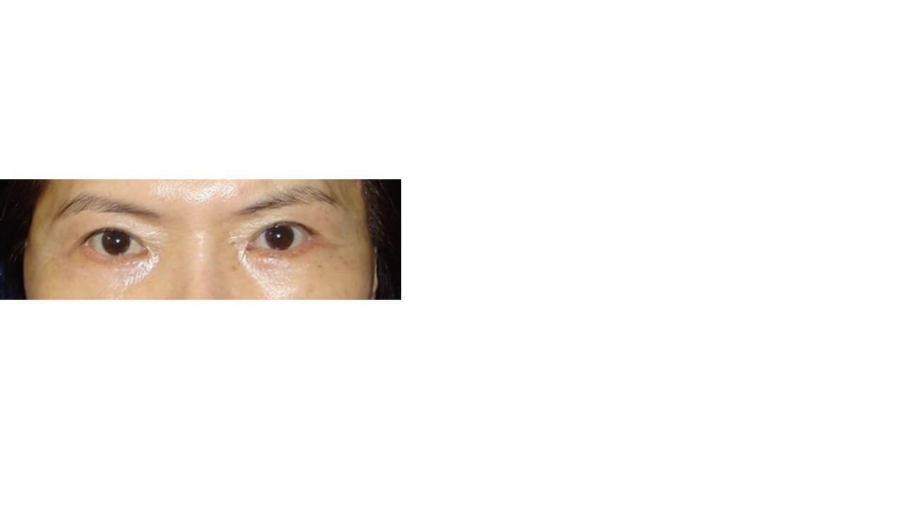 Lower Eyelid Surgery After