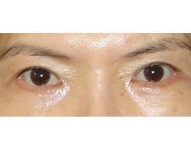 Lower Eyelid Surgery After