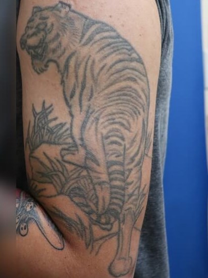 Laser Tattoo Removal Before