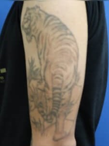 Laser Tattoo Removal After