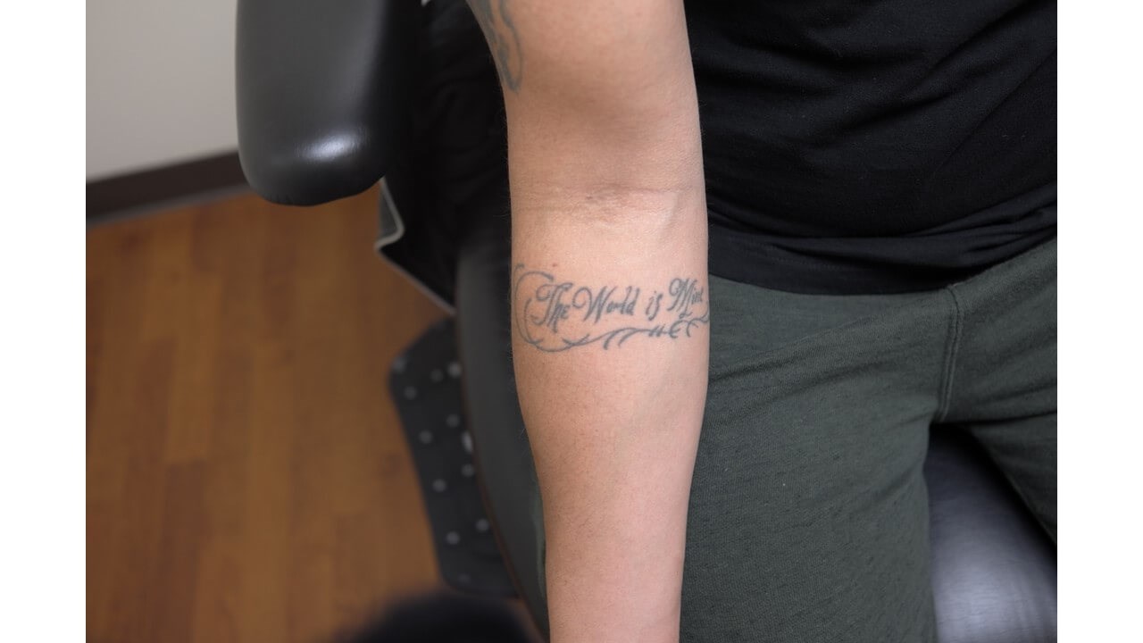 Laser Tattoo Removal Before