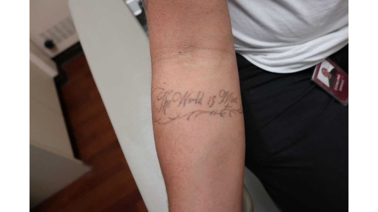 Laser Tattoo Removal After