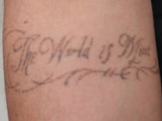 Laser Tattoo Removal After