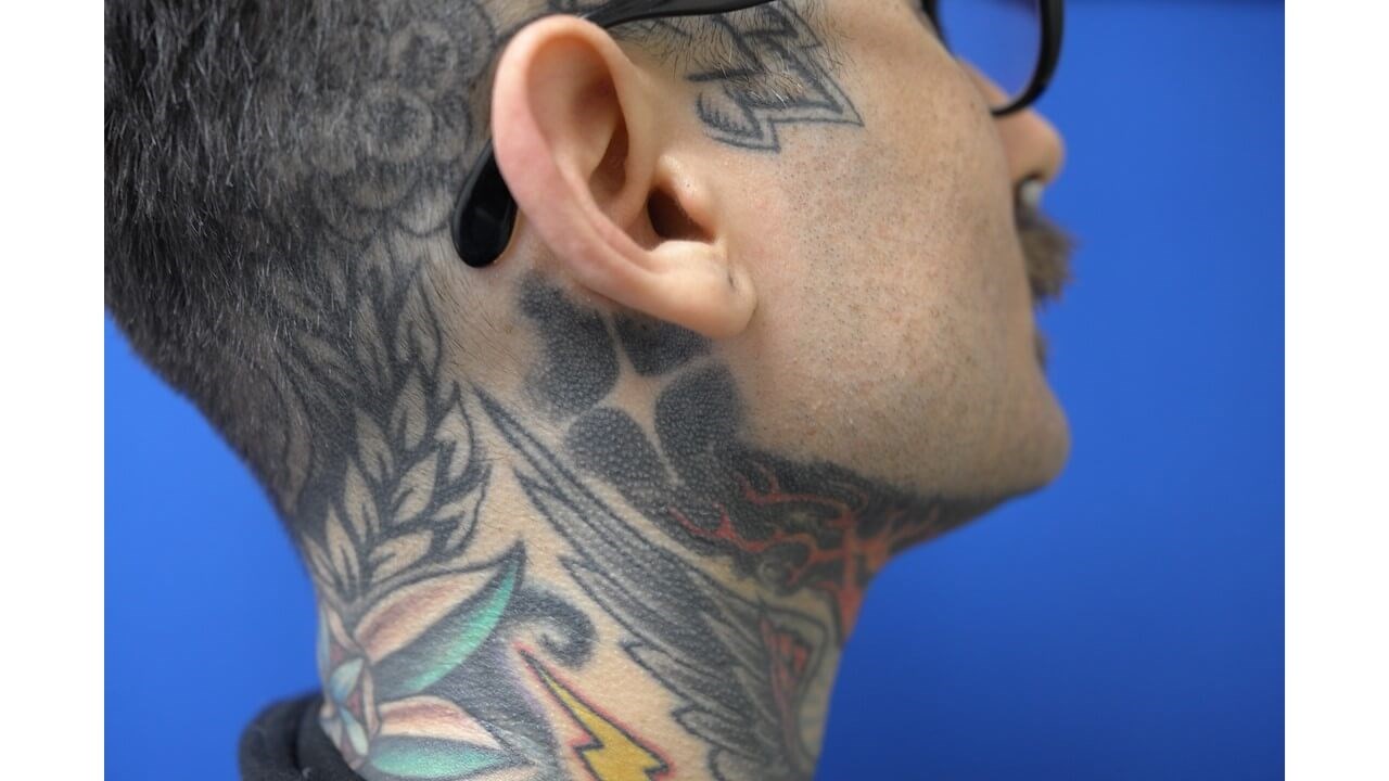 Laser Tattoo Removal Before