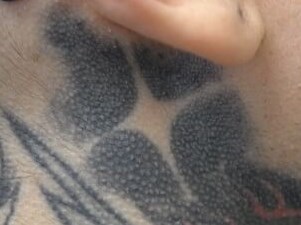 Laser Tattoo Removal Before