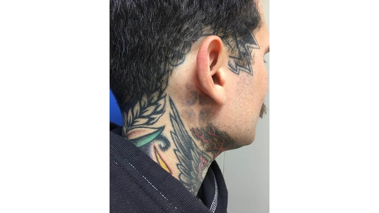 Laser Tattoo Removal After